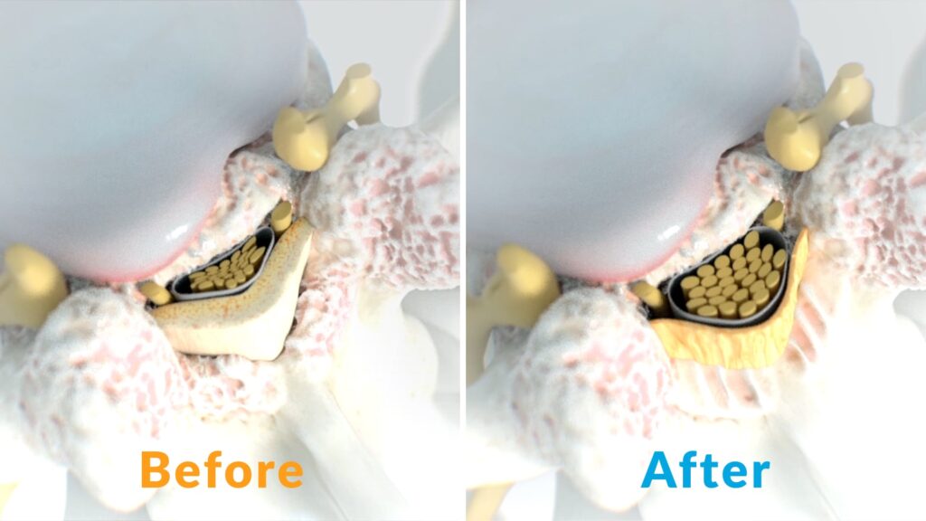 An illustration of the spine before and after Vertos Medical’s mild® procedure